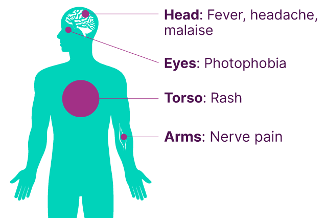 Diagrammatic figure of person with labels showing the symptoms of shingles