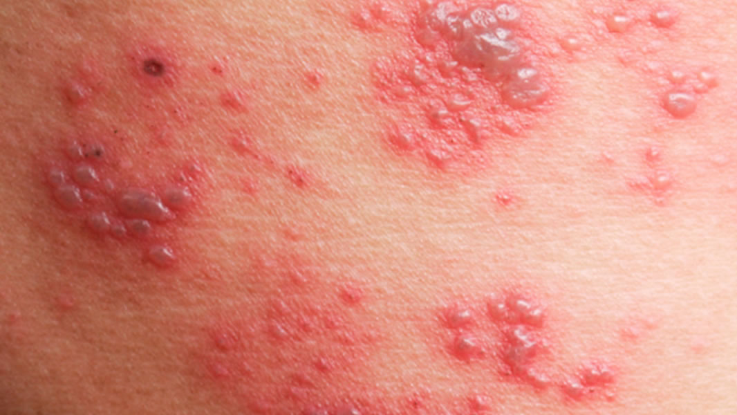 Common comorbidities